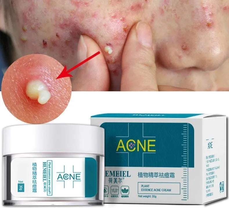 Acne Cream My Store